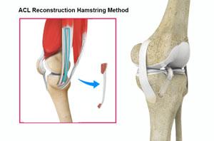 ACL Reconstruction Hamstring Method