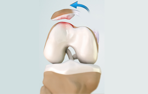 Recurrent Patella Dislocation