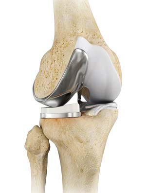 Unicondylar Knee Replacement